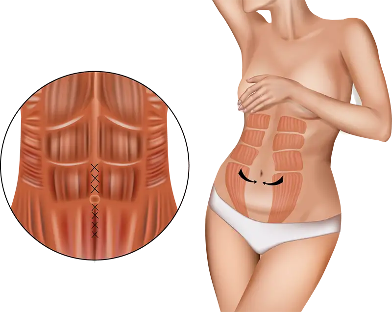 Mommy Makeover 3 Korrektur einer Rektusdiastase